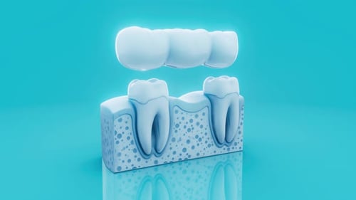 Conceptual 3D animation of a dental bridge