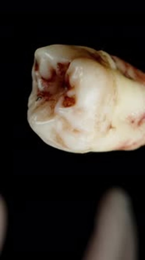 Decayed Molar with Cavity Close Up Studio Shot