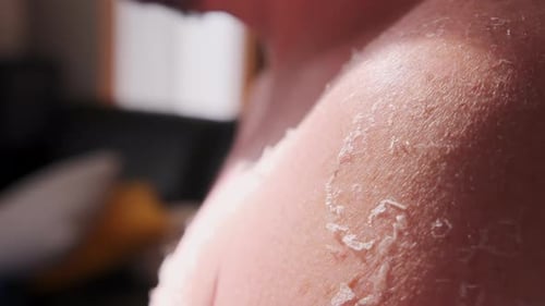 Nahaufnahme von Sonnenbrand auf männlicher Haut an der Küste