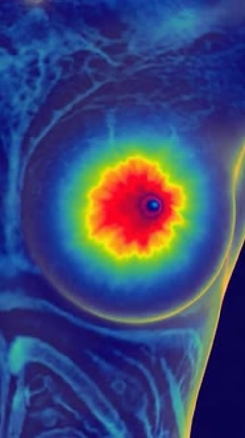 Breast Cancer - Malignant Tumor Thermal Imaging Scan 3D Medical Animation | Manestream Den