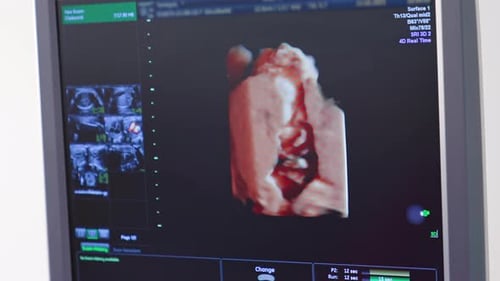 3D Ultrasound Showing Developing Fetus on Screen