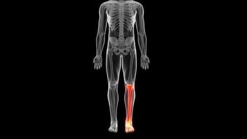 Human skeletal system highlighting the painful inflamed lower leg bones