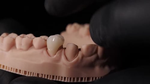 Ceramic Tooth Being Placed in Dental Mold