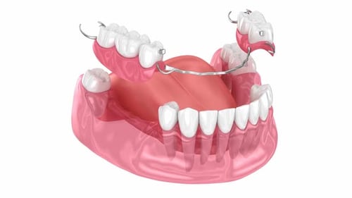 Removable partial denture, mandibular prosthesis. 3D animation