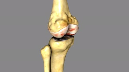 3D Animation of Human Knee Joint with Arthritis Symptoms