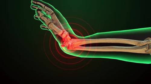 Human Wrist Anatomy with Pain and Inflammation Animation