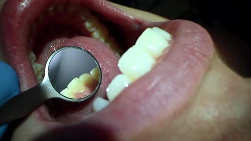 Dental Care Extreme Close Up Macro Video Dentist Treat Patient Teeth Orthodontist Works with