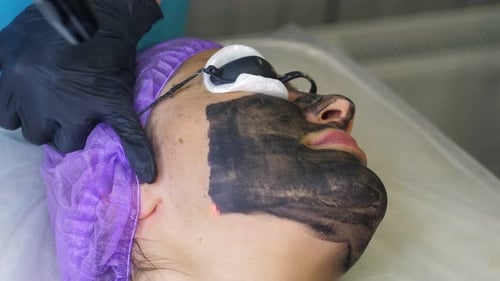 Woman Receiving Carbon Peel Treatment at Medical Spa