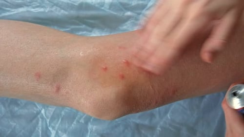 Doctor Hands Examining Leg Teenage Girl Allergy Closeup Child Scratches a Red Rash Nurse Applies