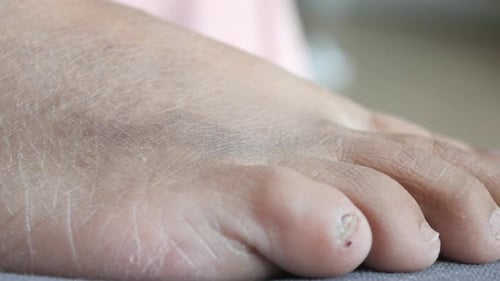 Nahaufnahme von Frauenfüßen mit Schwellungen