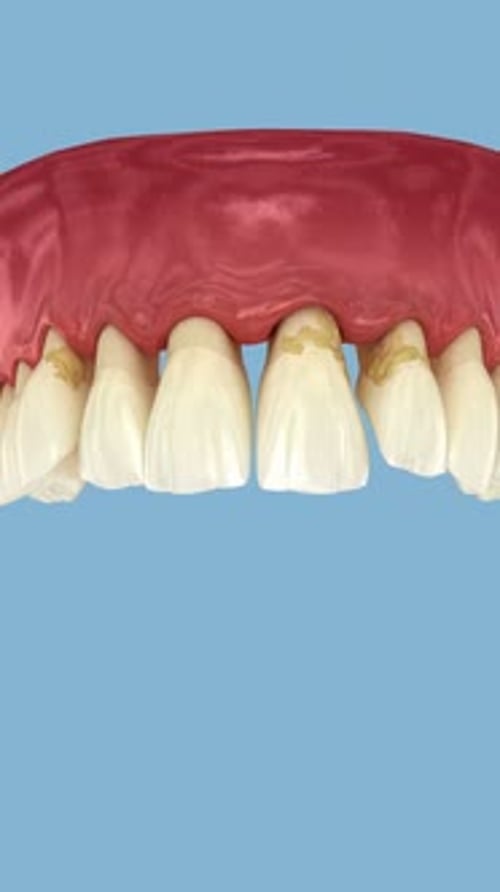 Periodontitis and gum recession in dynamics, teeth losing