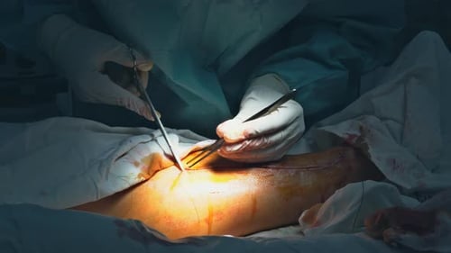 A Leg is Sewn Up in the Operating Room After a Major Accident By a Doctor