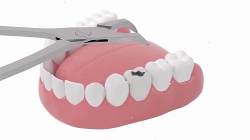 3D Animated Tooth Extraction with Cavity