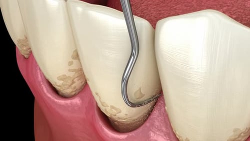 Laser removes a thin layer of infected skin, teeth cleaning