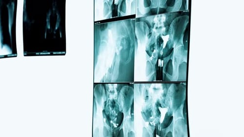 X-ray films displayed on a light box in Cameroon