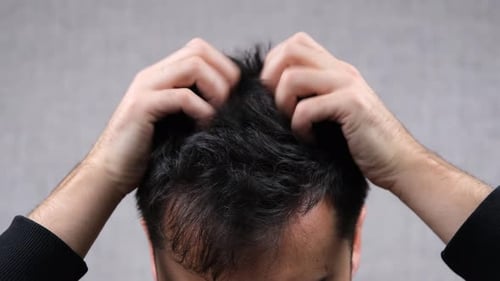 Man scratches head due to itchiness, close up