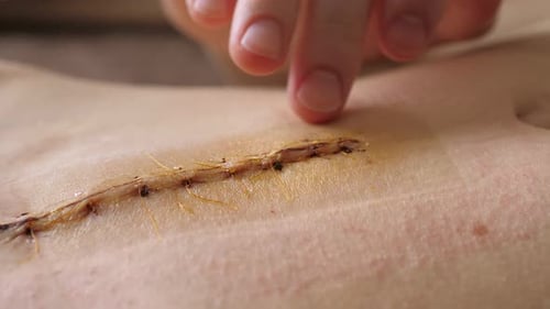 Abdomen of Young Girl Closeup Video of the Long Scar Above Navel After Abdominal Surgery for