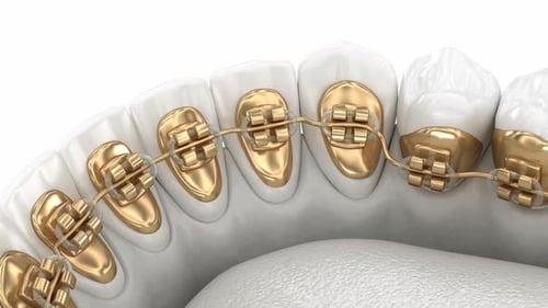 3D Animation of Lingual Braces Application on Lower Teeth