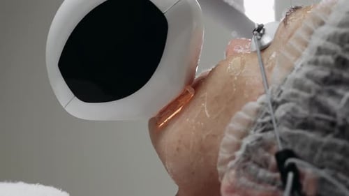 Skin Treatment Process Using a Laser Device at a Clinic