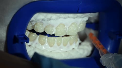 Dental Whitening Process in Patient Mouth Teeth Whitening with UF Lamp Led Lamp and Gel Dental