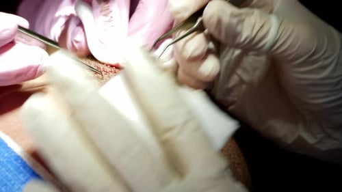Hair Transplant Surgery Close Up Medical Procedure