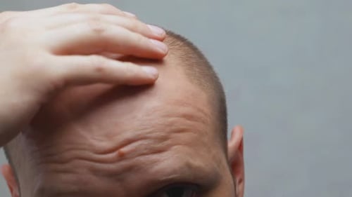 A Man Touches His Balding Head and Forehead with His Hands Closeup