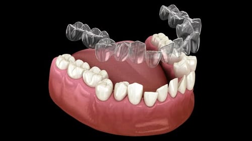 3D Animation of Teeth Alignment with Clear Aligners