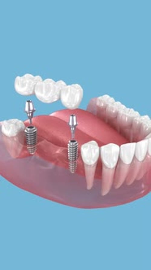 Dental bridge based on two implants