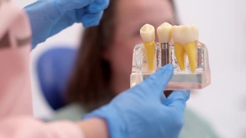 Dental Implant Model in Modern Clinic Showing Teeth Implantation Crown Healthy Teeth Treatments