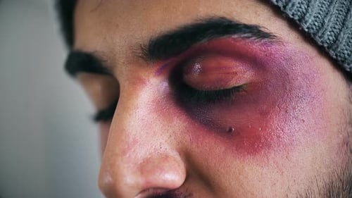 Das Auge eines verwundeten und lebhaften jungen Mannes — Nahaufnahme