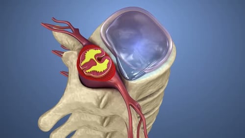 Herniated Disc Spinal Nerve Compression Medical Animation
