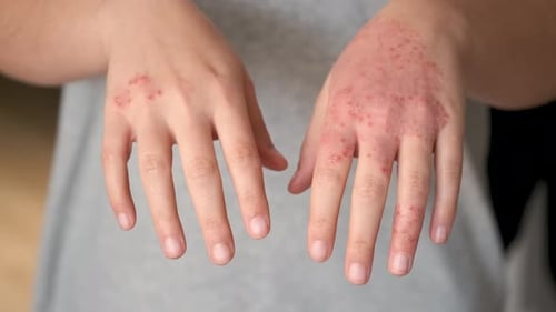 Unerkennbare Frau mit Ekzemen an den Händen, atopischer Dermatitis.