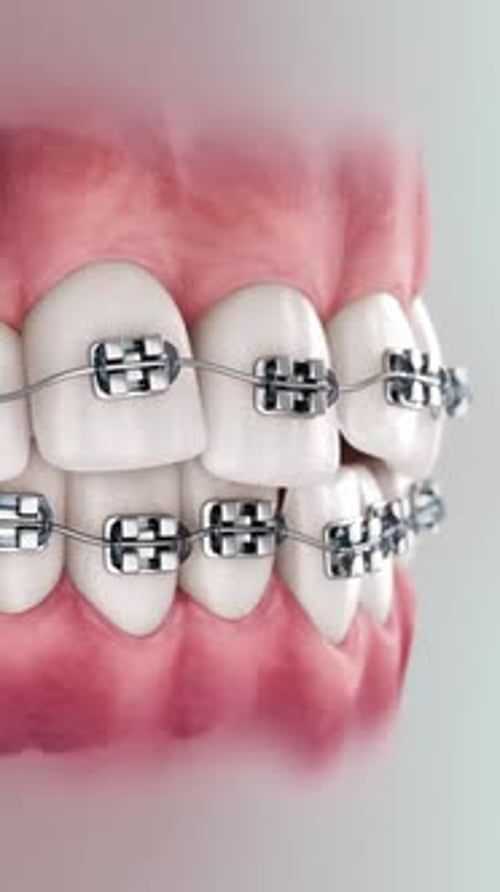 Brackets Up 9x16 003