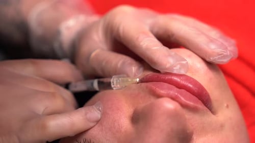 Lip Augmentation Procedure with Cosmetic Injection