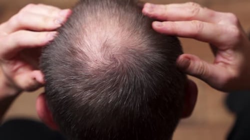 Mann mit Haarausfallproblemen aus nächster Nähe