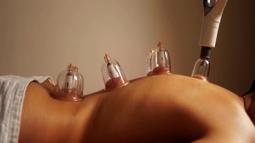 Woman getting cup therapy at spa. Chinese vacuum suction treatment for pain relief