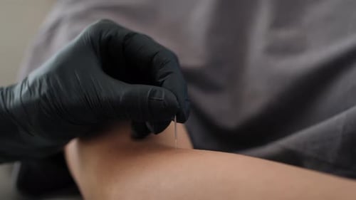 Nahaufnahme eines Akupunkturspezialisten, der aufgrund der Behandlung die Nadel in die Hände des Patienten einführt. Mit RE geschossen
