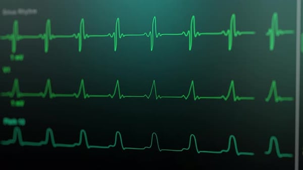 Patient Monitor Displays Vital Signs ECG Electrocardiogram EKG Oxygen ...