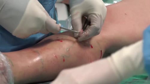 Varicose Veins 8