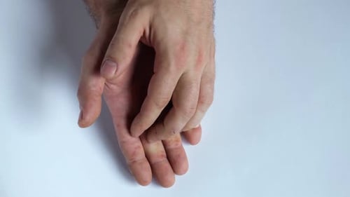 Red Bumps on Man's Hands Close Up