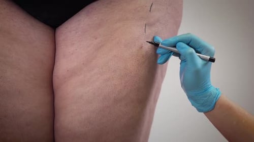 Female Caucasian Hand in Medical Gloves Drawing Lines on Fat Woman's Leg. Plastic Surgeon Preparing