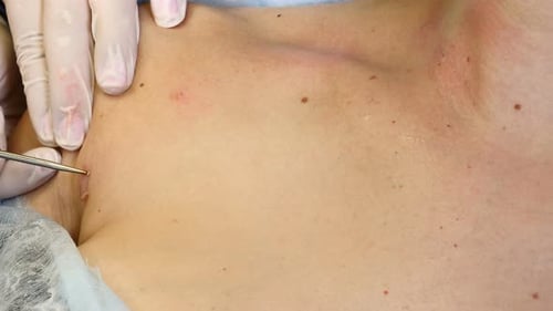 Operations-Konzept. Elektrokoagulation von Papillomen. Nahaufnahme von Doktor Burns Papillomavirus mit