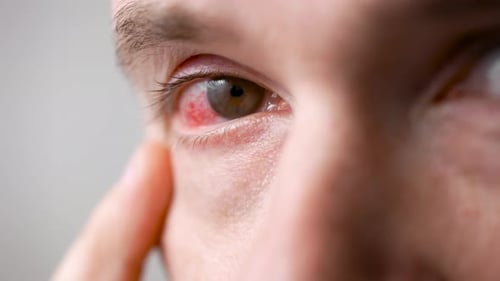 A Man with a Red Sore Eye