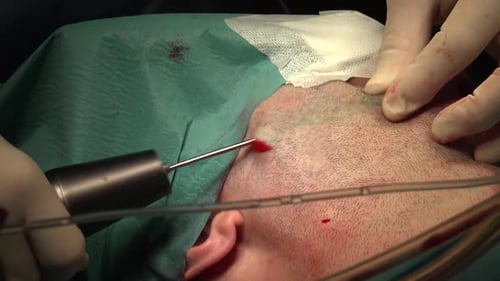 Close Up of Scalp Medical Procedure