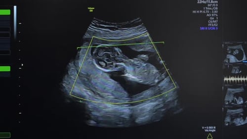 Ultrasound of Pregnant Woman