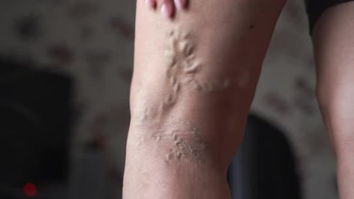 Venas varicosas en las piernas de la mujer en interiores Problema de salud vascular. Trombosa en piernas femeninas
