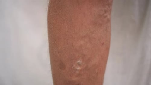 Venas varicosas y manchas de la edad en la pierna humana