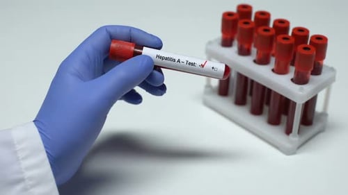 Positive Hepatitis A Blood Test Sample in Lab
