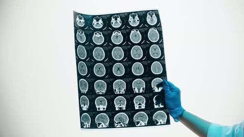 Gloved Hand Holds Brain Scan X-Ray Image