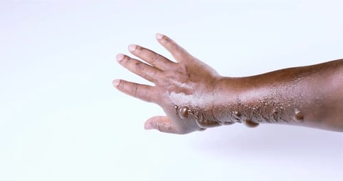 Arm with Blisters Close Up on White Background